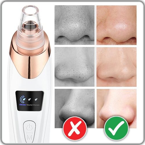 ELEKTRYCZNY PRZYRZĄD ODKURZACZ DO WĄGRÓW PRYSZCZY ZASKÓRNIKÓW 15w1 na Arena.pl