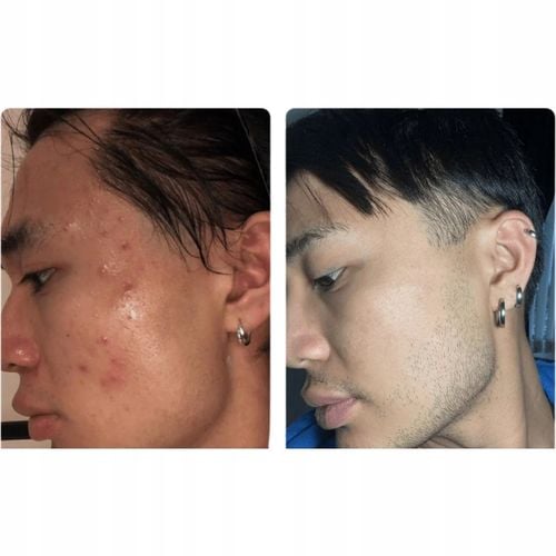 ISOSKIN Spray Podchloranowy 100 ml - Oczyszcza skórę, Łagodzi na Arena.pl