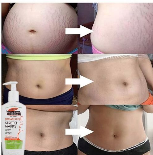 Dobry krem na rozstępy dla nastolatków na plecach brzuchu udach ramionach na Arena.pl