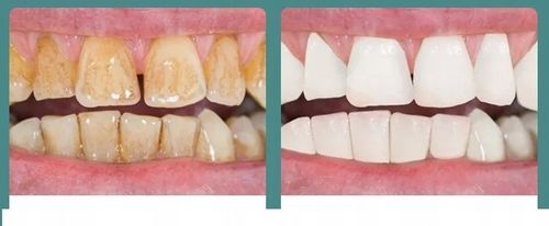 SKALER ULTRADŹWIĘKOWY DO ZĘBÓW DENTYSTYCZNY SMART USUWANIE KAMIENIA na Arena.pl