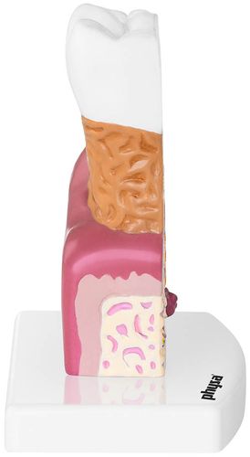 Chory ząb - model anatomiczny Physa PHY-TM-1 na Arena.pl