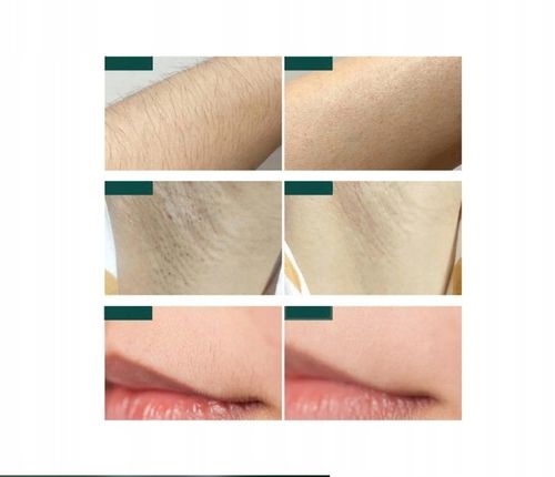 DEPILATOR IPL DO WŁOSÓW CIAŁA LASEROWY BIKINI NÓG DEPILACJA BEZBOLESNY na Arena.pl