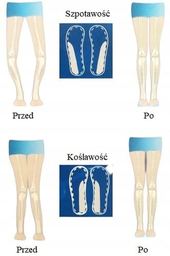 Wkładki Ortopedyczne Koślawość Szpotawość 2 Sztuki na Arena.pl