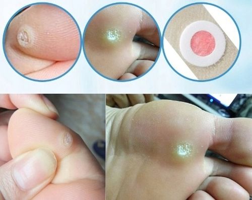 Plastry Usuwające Kurzajki na odciski 30szt na Arena.pl