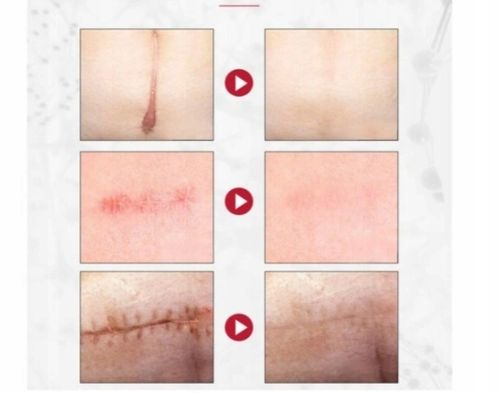 Dermatix Ultra Silikonowy Żel Do Leczenia i Zapobiegania Blizn 15g na Arena.pl