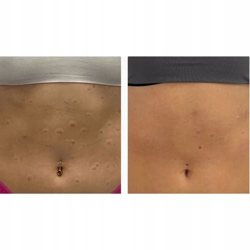 ISOSKIN Spray Podchloranowy 100 ml - Oczyszcza skórę, Łagodzi na Arena.pl