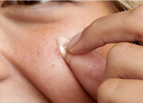 Plastry hydrokoloidowe na wypryski pryszcze 72 szt na Arena.pl