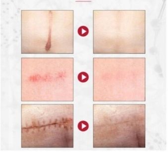 Dermatix żel na blizny 15 g zdjęcie 4