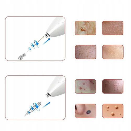 Laser Pen Plazma usuwanie tatuażu, blizn,brodawek 9 regulowanych poziomów na Arena.pl