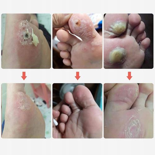 Plastry Usuwające Kurzajki na odciski Odcisków Stóp Plastry 42 Szt na Arena.pl