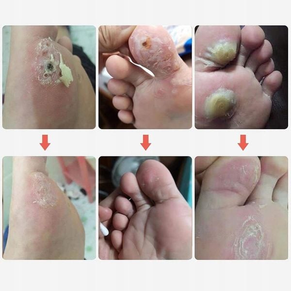 Plastry Usuwające Kurzajki na odciski Odcisków Stóp Plastry 42 Szt zdjęcie 10