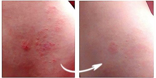 Blue CAP Krem Skóra Egzema Łuszczyca Łojotok Atopowe Zapalenie 50g na Arena.pl