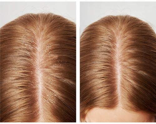 Szampon do włosów PRZECIWŁUPIEŻOWY Z PIROKTONEM OLAMINY cynk NUTRIDOME na Arena.pl