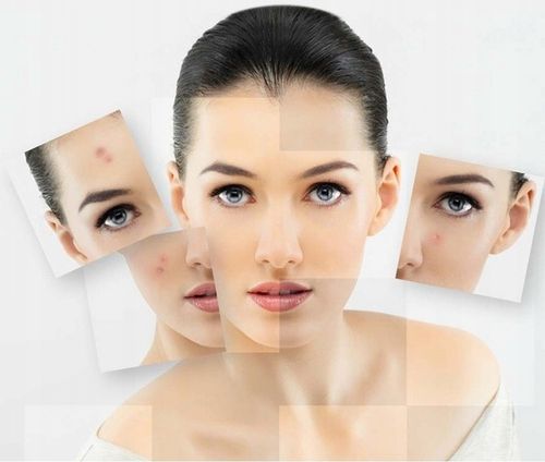 ZESTAW DO USUWANIA BRODAWEK ZMIAN SKÓRNYCH TATUAŻY BLIZN PLAZMA PEN LASER na Arena.pl