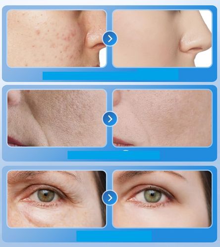 Maska do twarzy LED do terapii światłem KIMTAR na trądzik i zmarszczki na Arena.pl