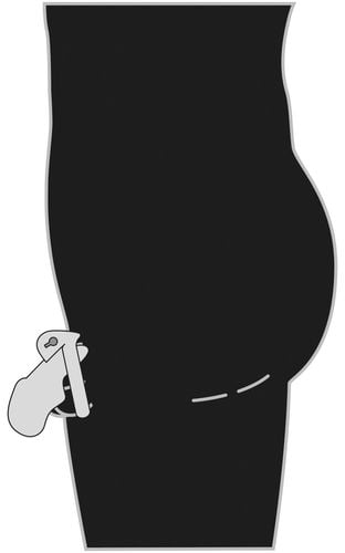 penis cage glans na Arena.pl