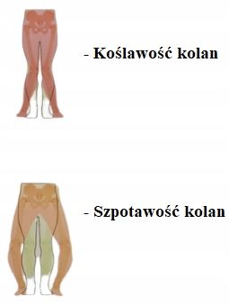 STABILIZATOR ORTEZA KOLANA NA SZPOTAWOŚĆ KOŚLAWOŚĆ zdjęcie 7