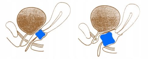 Pessar kostkowy perf. z guzikiem Dr. Arabin, 2/32 mm na Arena.pl