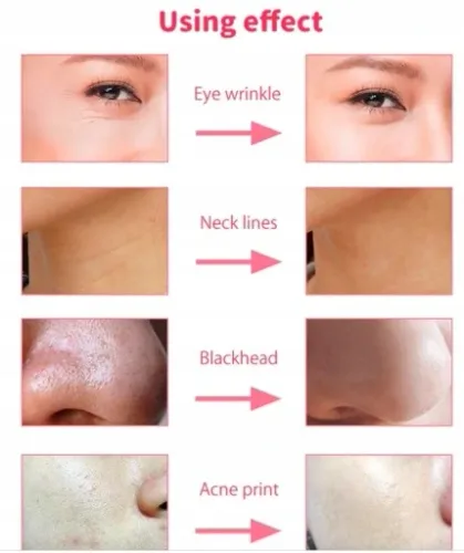 DIAMENTOWA MIKRODERMABRAZJA LIFTING Mocna 100W na Arena.pl