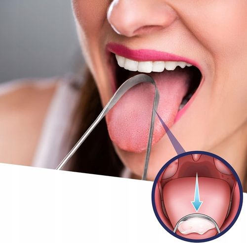 Zestaw LED do usuwania kamieni migdałkowych GRATIS na Arena.pl