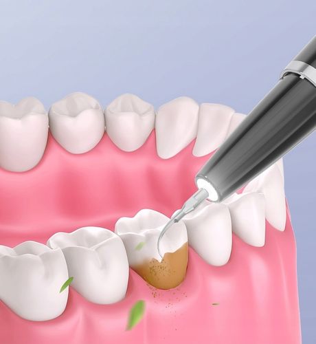 Skaler Ultradźwiękowy Do Zębów - 5 trybów do usuwania kamienia nazębnego na Arena.pl