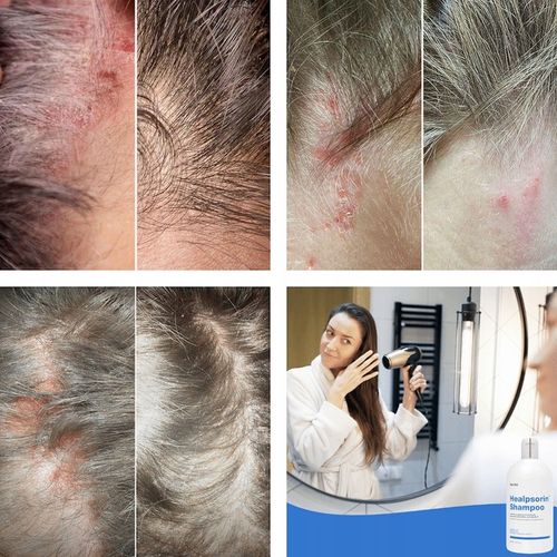 Łuszczyca AZS ŁZS Egzema Szampon Hermz Healpsorin na Arena.pl