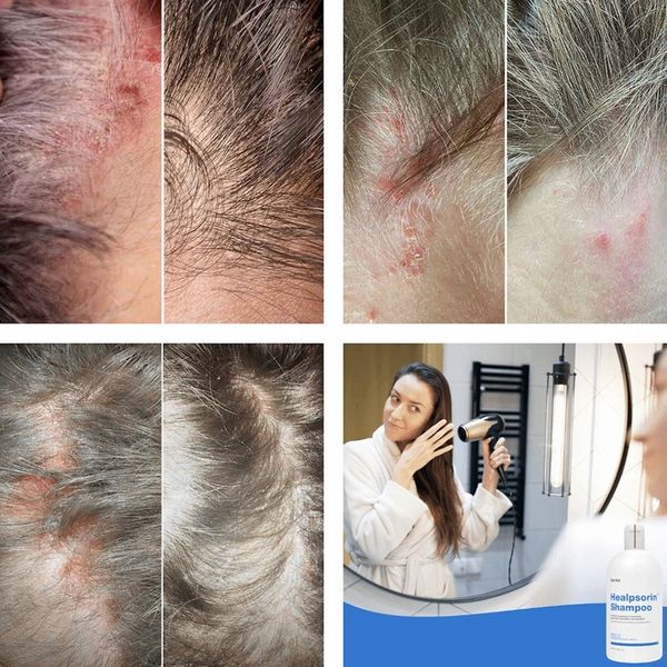 Łuszczyca AZS ŁZS Egzema Szampon Hermz Healpsorin zdjęcie 2