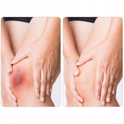 Plastry hydrokoloidowe ochronne szybkie gojenie odcisków pęcherzy na Arena.pl