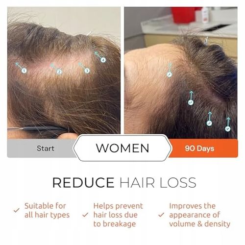 Spectral DNC-N z NANOXIDIL stymuluje porost włosów, powstrzymuje wypadanie na Arena.pl