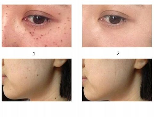 PLAZMA PEN LASER DO USUWANIA BRODAWEK PIEPRZYKÓW DŁUGOPIS PIÓRO DLA KOBIETY na Arena.pl