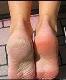 PĘKAJĄCE PIĘTY Gehwol OKLUZJA Regeneracja na Arena.pl