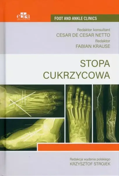 Stopa cukrzycowa zdjęcie 1