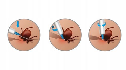 Lasso TRIX usuwanie kleszczy dla ludzi i zwierząt przyrząd do usuwania na Arena.pl