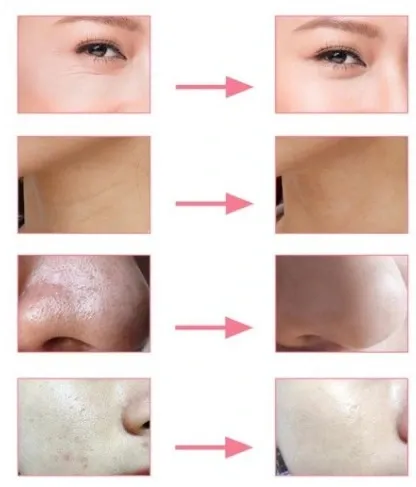 DIAMENTOWA MIKRODERMABRAZJA LIFTING Mocna 100W na Arena.pl