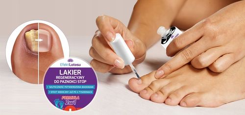 LAKIER PREPARAT NA GRZYBICĘ PAZNOKCI STÓP PRZECIWGRZYBICZNY OCHRONA 3x na Arena.pl