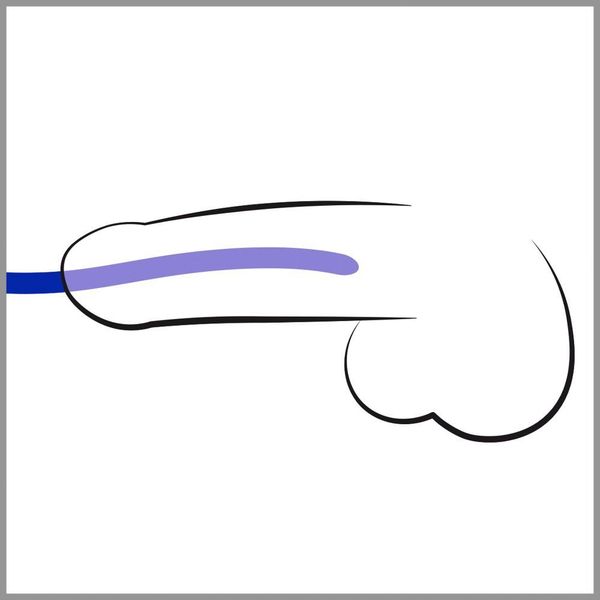 Silicone Dilator Set zdjęcie 3