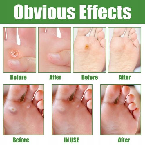 Plastry Usuwające Kurzajki na odciski 30szt na Arena.pl