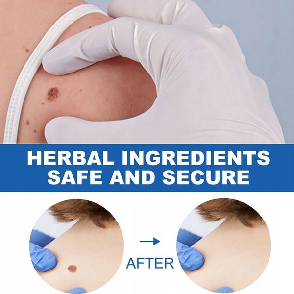 Oryginalne Pióro Do Usuwania Brodawek zdjęcie 3