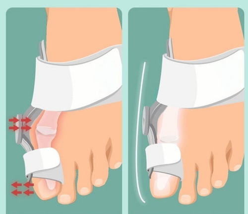 Uniwersalny aparat na haluksy regulowany separator korekcyjny biała orteza na Arena.pl