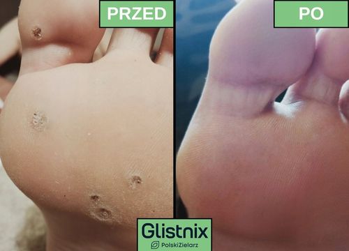 Glistnik Jaskółcze Ziele Kurzajki Brodawki Modzele MOCNY 10 ml na Arena.pl