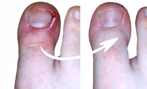 Spray na grzybicę paznokci stóp ze srebrem 250ml Srebro Koloidalne na Arena.pl