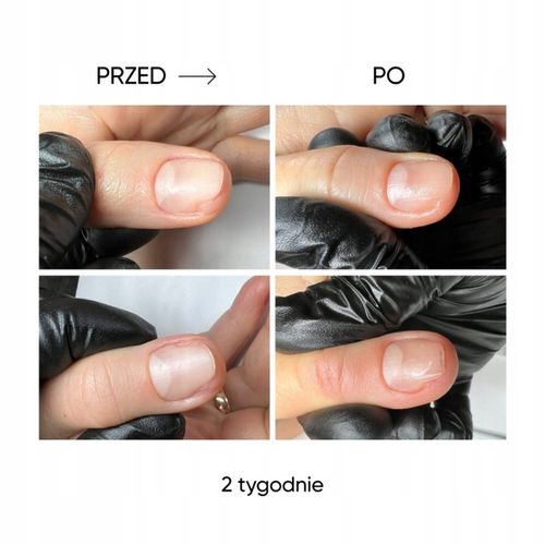 Onycholiza stop! Olejek do paznokci przeciw onycholizie NOTD Onistop 8 ml na Arena.pl